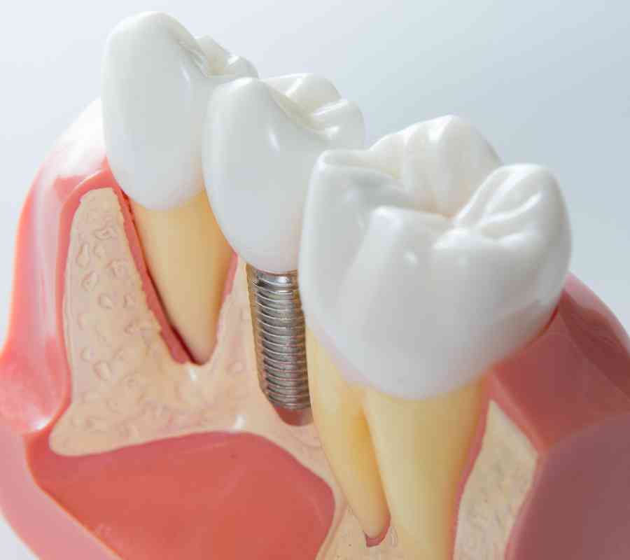 Implantes dentales